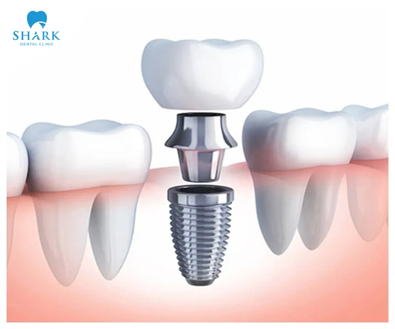 There are many different lines of implant analogs in use today, and each one carries its own distinct characteristics in terms of safety and overall effectiveness