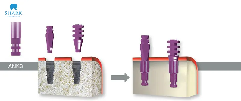 The process of fabricating the implant analog is carried out in a highly specialized way, with the support of an experienced team of specialist doctors and dentists