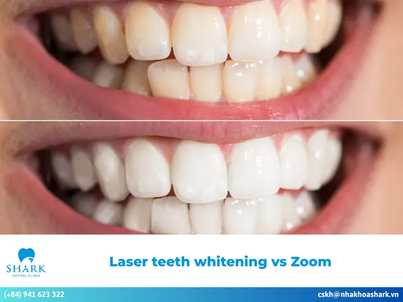 Laser teeth whitening vs zoom teeth whitening technology