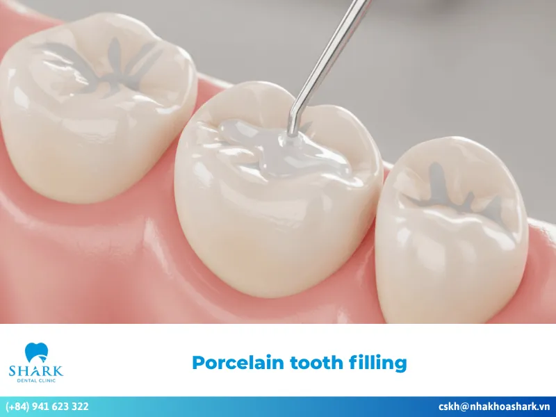 Porcelain tooth filling: Differences compared to other methods