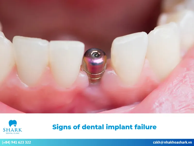 Signs of dental implant failure: Causes & effective fixes