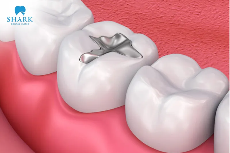 A GIC filling can be applied quickly and safely, all while minimizing the overall impact on the surrounding tooth structure
