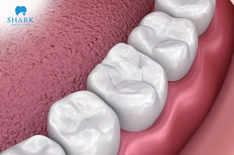 Composite fillings are generally regarded highly both for their aesthetic appeal and for their durability over the long term