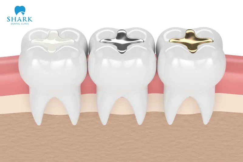 GIC fillings are able to maintain their color and appearance over time, especially when the procedure is performed at a reputable clinic and the tooth is properly cared for afterward