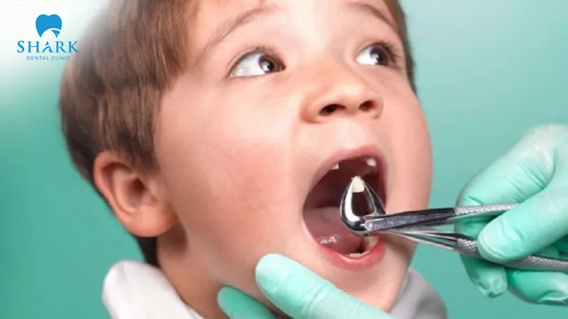 Whether to choose a baby tooth filling or a baby tooth extraction will ultimately depend on the specific recommendation given by a specialist dentist