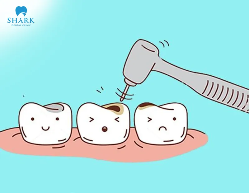 A filling is generally the right approach in cases of mild tooth decay, where the situation can still realistically be improved and corrected