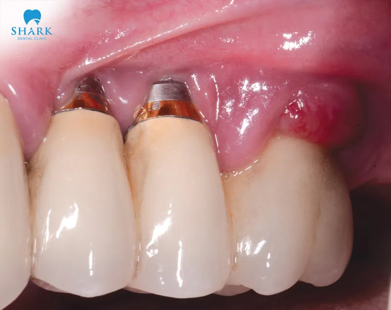 Peri-implant mucositis around dental implant requires clinical assessment, including gentle probing, and radiographic comparison when indicated.
