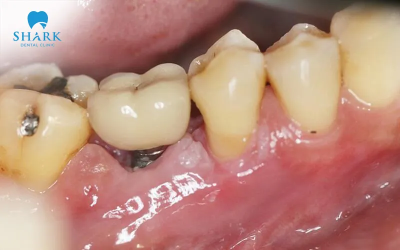 There are many different causes that can lead to the appearance of peri-implant mucositis around the implant