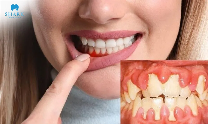 Peri-implant mucositis around a dental implant does not cause as much pain as many people tend to think
