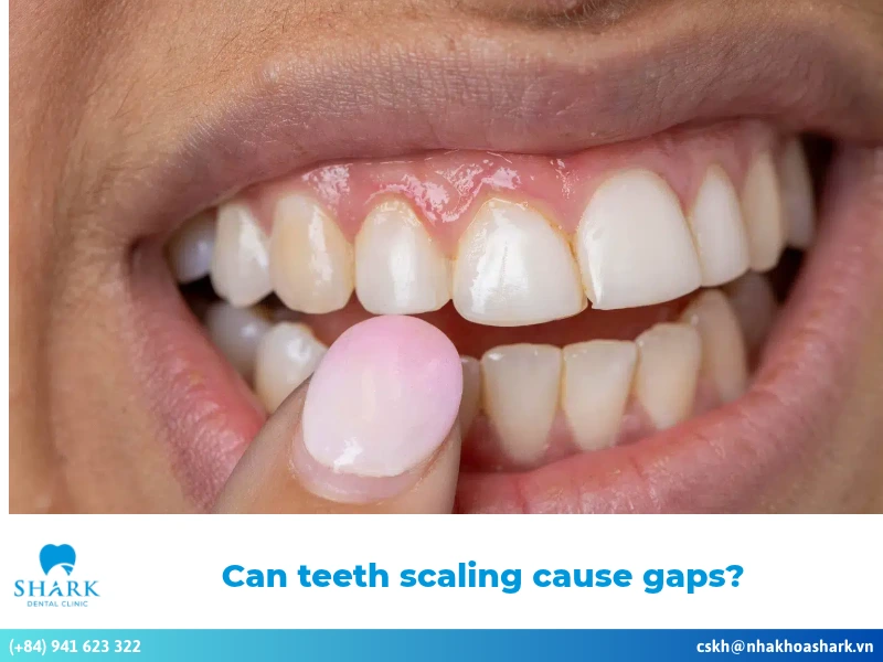 Can teeth scaling cause gaps, and what are other effects?
