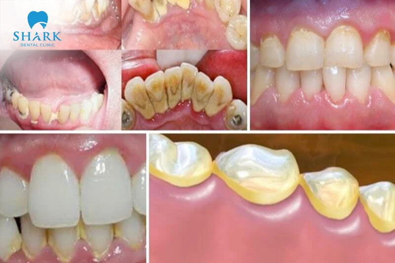 Teeth scaling helps thoroughly clean the teeth and minimizes irritation