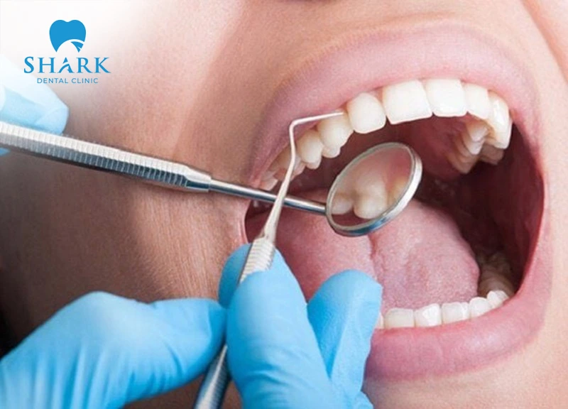 The gaps that appear after teeth scaling will vary depending on the specific case involved
