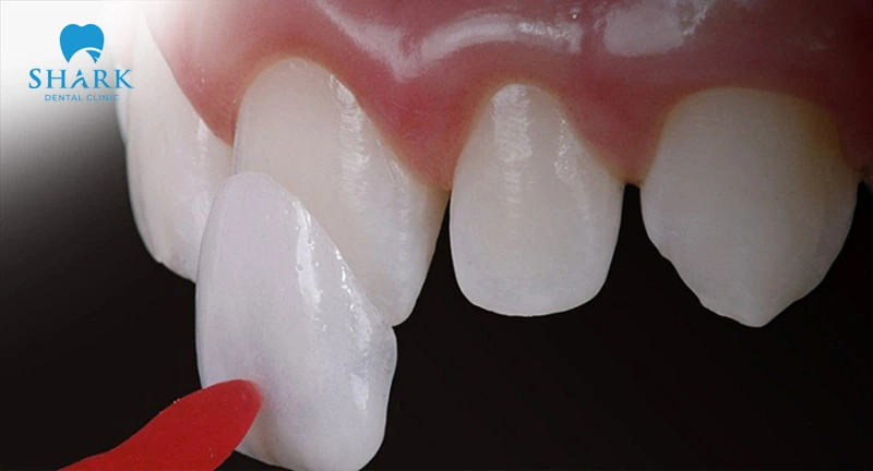 Treatment for persistent spaces depends on periodontal health, tooth position, bite, and aesthetic needs; veneers are only one possible option.