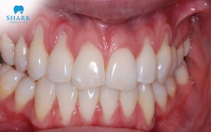 The condition of the gums will vary from case to case after teeth scaling has been carried out