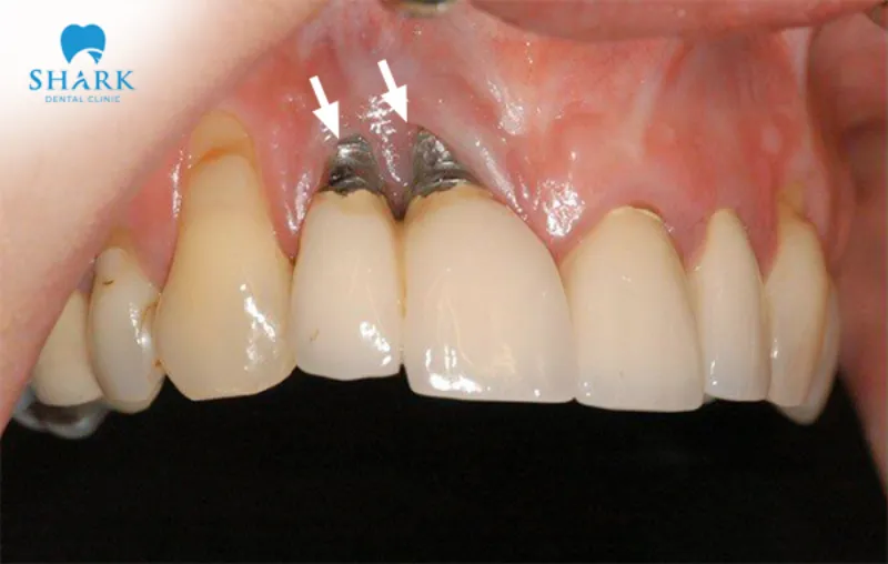 Swelling and inflammation of the gums is one of the common signs of dental implant failure