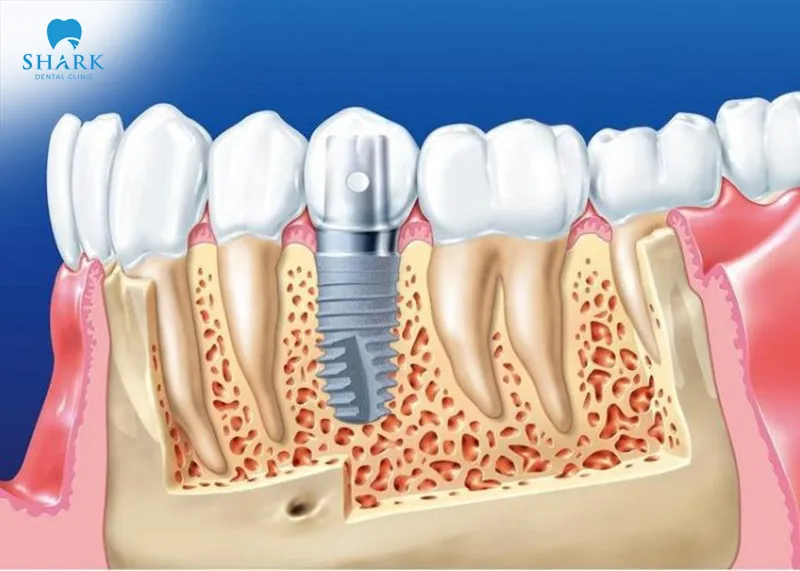 Early rejection often appears 1-2 weeks after the dental implant has been placed