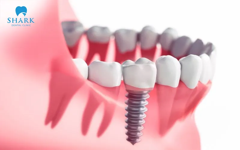 There are many different underlying causes behind the phenomenon of implant failure after a dental implant has been placed