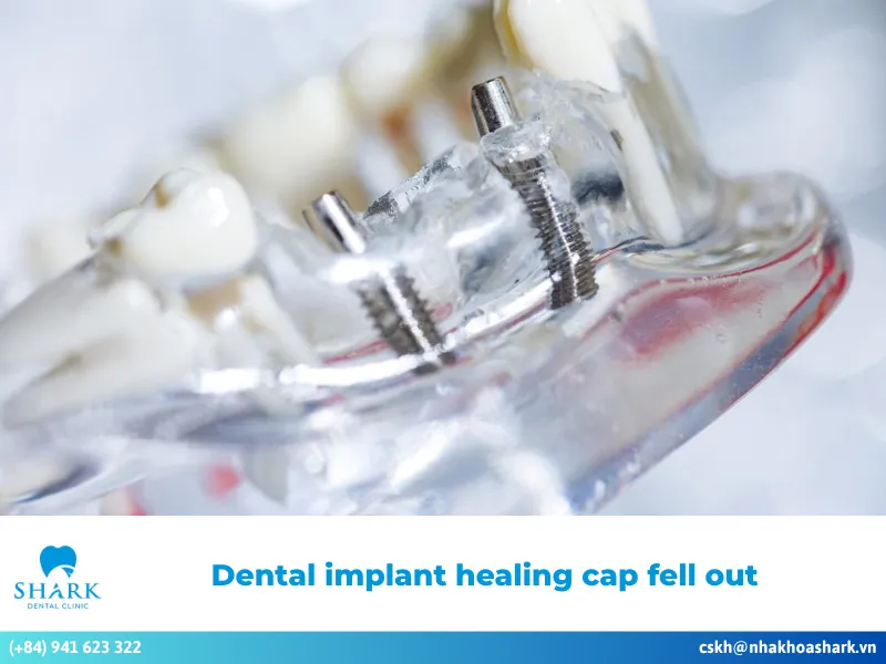 Dental implant healing cap fell out? Key causes and what to do