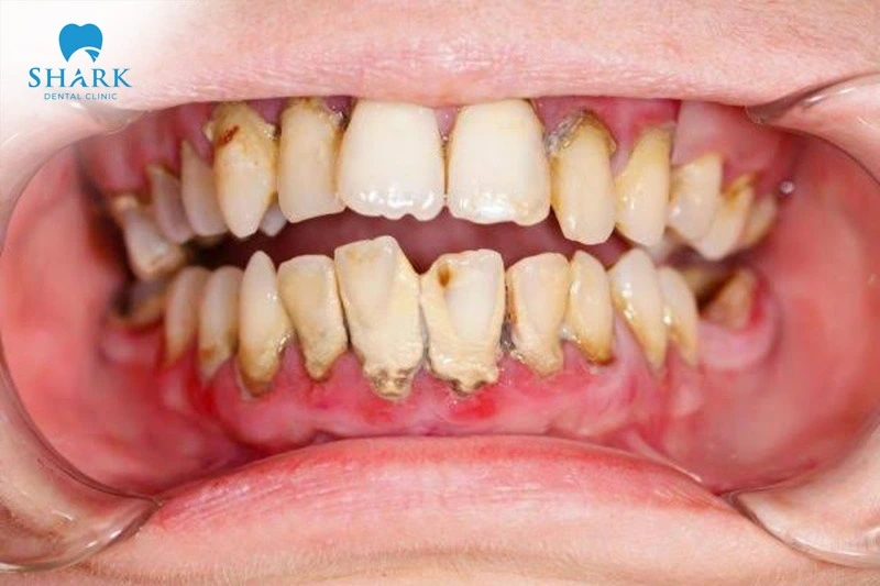 Tartar buildup causes inflammation, irritation, and damage to the teeth