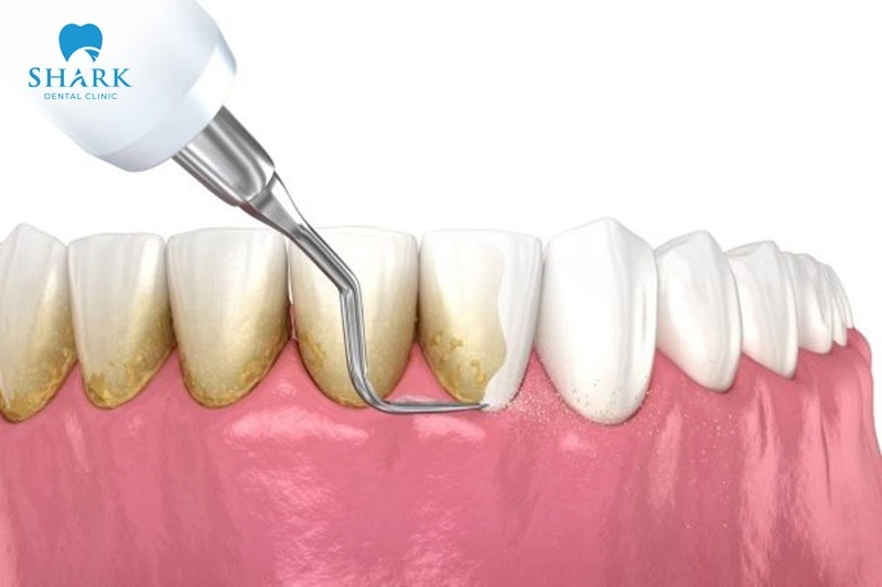 Tartar buildup forms quickly, so proper daily dental care really matters