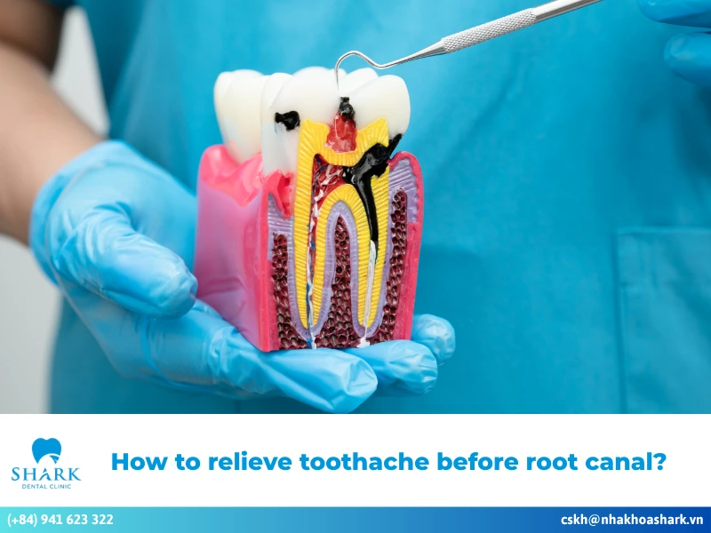 How to relieve toothache before root canal: 5 fast relief tips