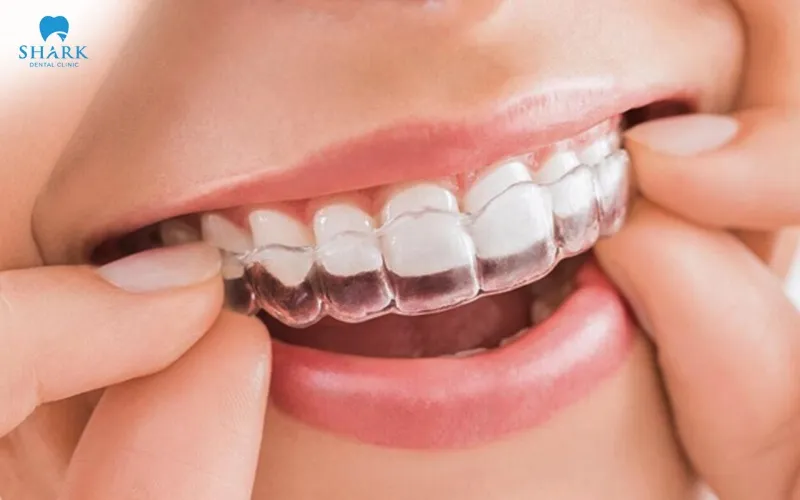 Custom-fitted trays are designed by the dentist based specifically on an impression taken of each individual person's teeth