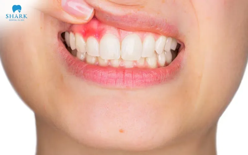 Whitening gel that leaks out and comes into contact with the gums or the soft tissue inside the mouth can cause a mild degree of gum irritation