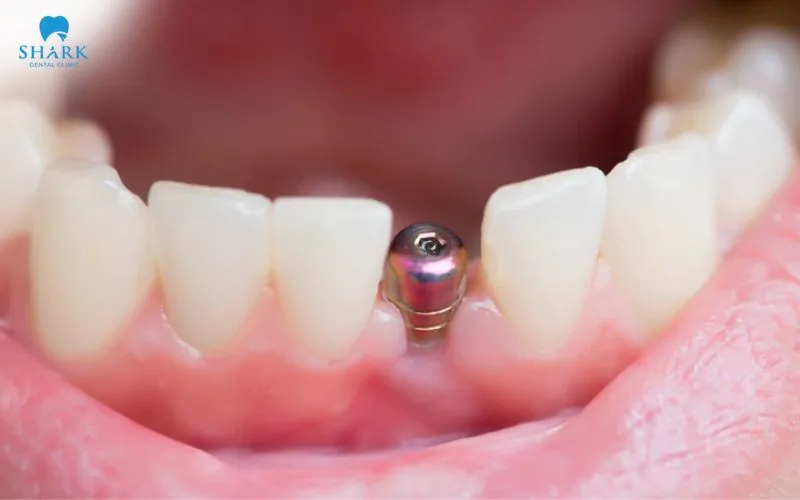 When a healing cap falls out, you should not screw it back in on your own initiative, as this can affect your oral health