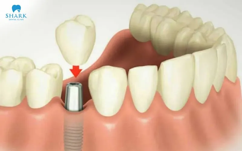 The gingival former works as a space holder that guides the gum tissue while it heals