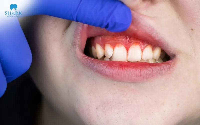 If your gums show signs of swelling, redness, or prolonged pain, you should see a dentist promptly for an exam and appropriate treatment