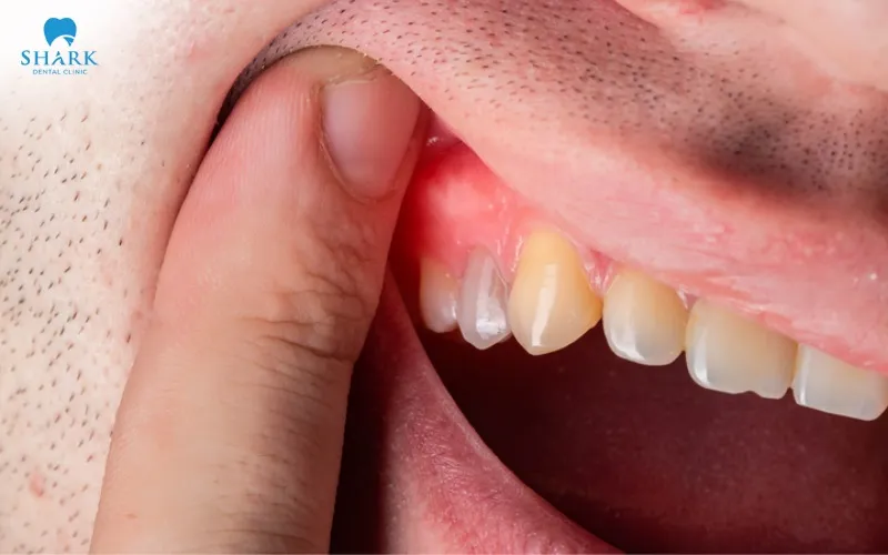 You should prioritize choosing products that match your particular gingivitis condition in order to increase treatment effectiveness