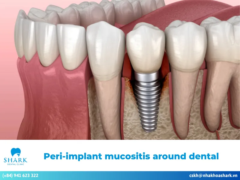 Solutions for peri-implant mucositis around dental implants.