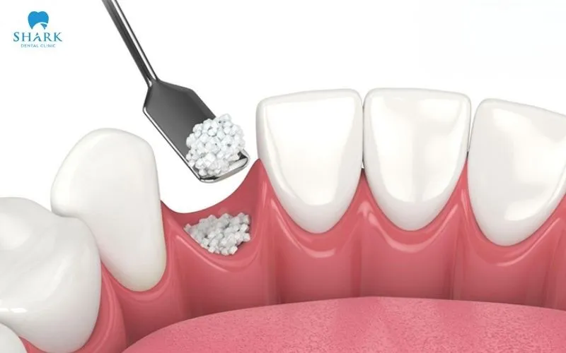 The recovery time differs from person to person and is not fixed; it depends on the amount of bone that has been lost and the size of the grafted area