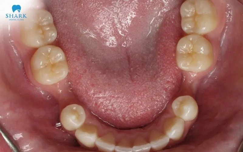Dental bone loss is a situation in which the part of the bone whose function is to support the teeth declines in volume and in density, so that the foundation holding the teeth up becomes weaker and weaker