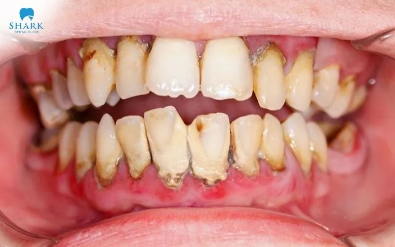 Periodontal disease is one of the causes most commonly seen behind loss of the alveolar bone, brought about by plaque and bacteria that build up over a long period
