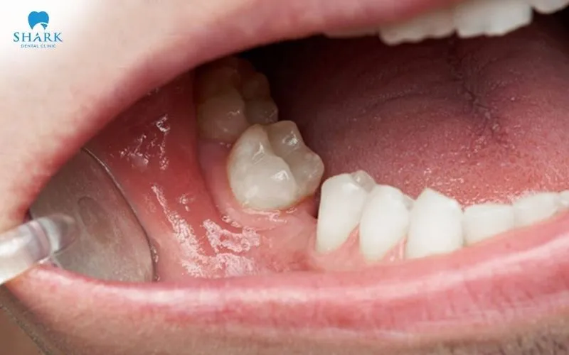 Losing a tooth for a long period of time means the bone can gradually be reduced in volume and in density, because it is no longer stimulated the way it used to be