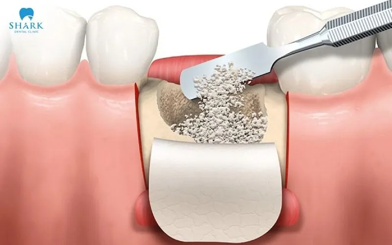 Bone grafting is a method of adding bone or a bone substitute material into the area where there is a deficiency