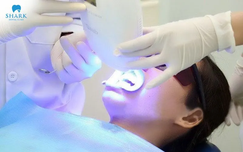 Laser teeth whitening is a method of whitening the teeth that combines a whitening gel containing hydrogen peroxide with a high-powered laser beam