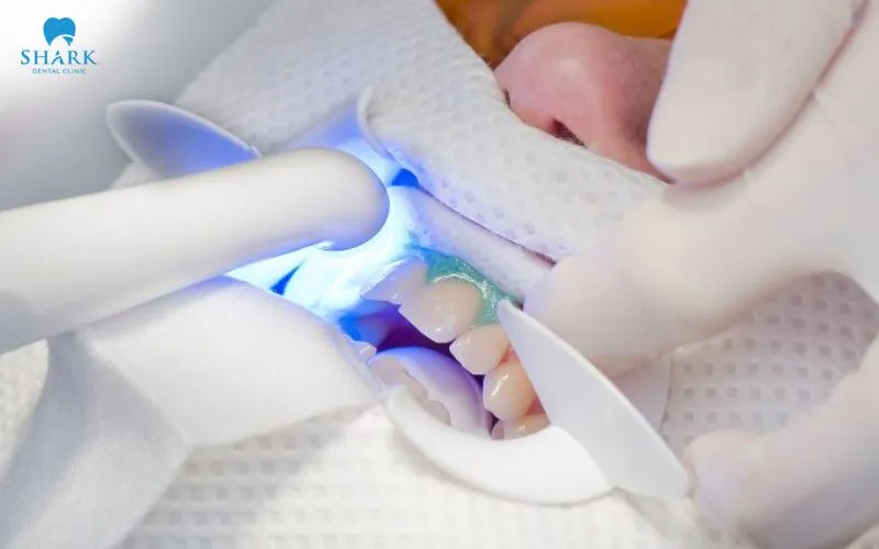 Zoom teeth whitening is a method of whitening the teeth that combines the use of an LED light in order to help speed up the process of removing the pigments that cause the teeth to appear yellow