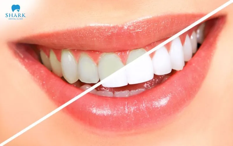 There is no single method that is absolutely suitable for you; the choice should be based on the condition of your teeth, the extent of the discoloration, and your own personal aesthetic needs