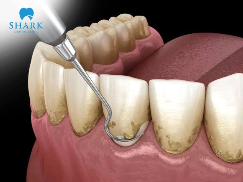 The teeth scaling procedure is carried out safely, with minimal pain and minimal impact overall