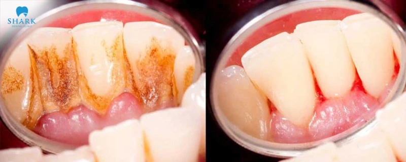 After scaling, it's common to notice some bleeding, mild swelling, and a bit of sensitivity