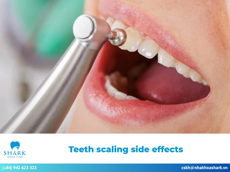 Learn about teeth scaling side effects and how to manage them