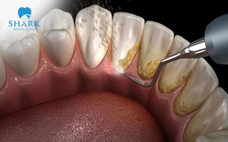 If you notice a significant buildup of plaque near the gumline, you should promptly schedule a scaling procedure at a dental clinic