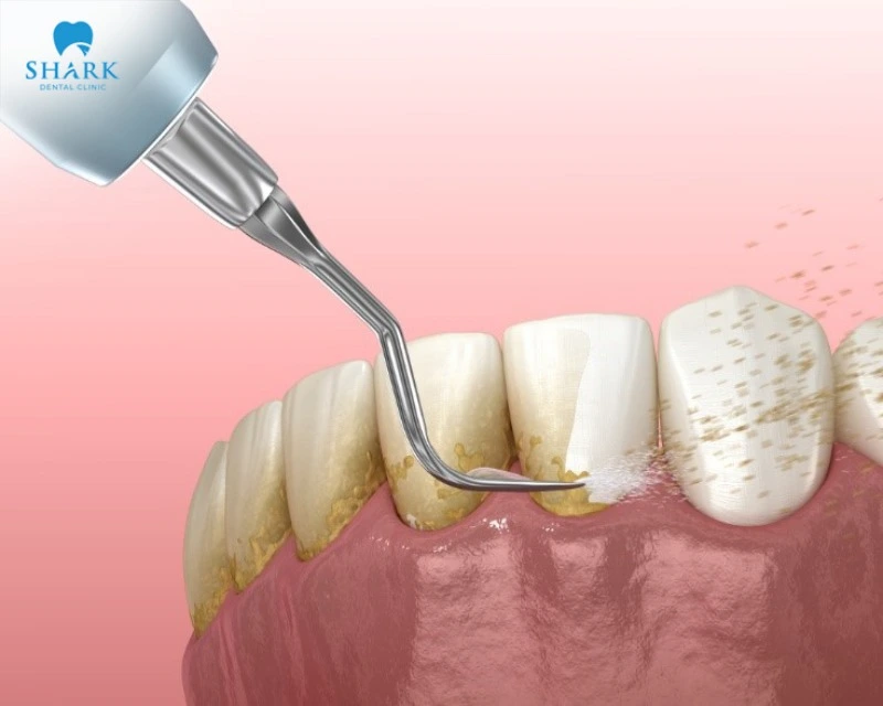 Scaling only affects the surface of the tooth and doesn't cause any lasting damage to the enamel
