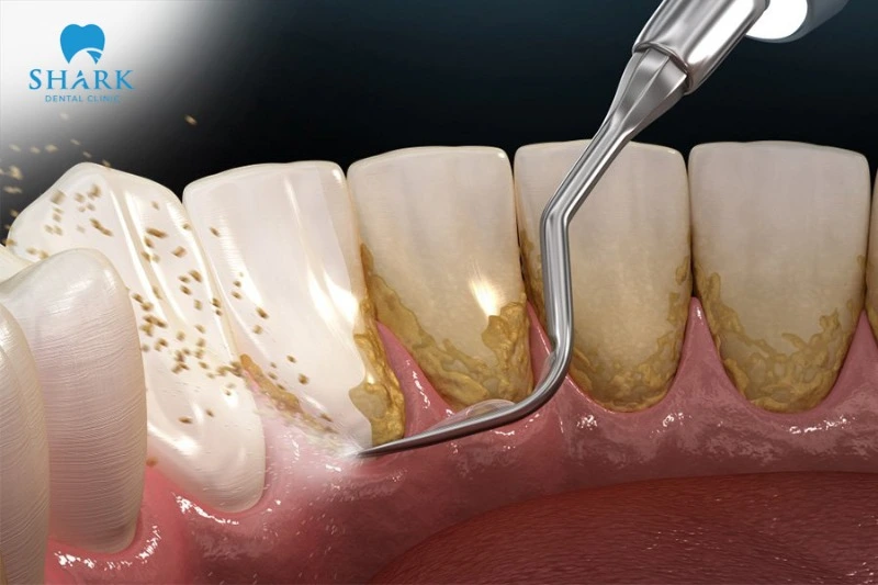 A dental cleaning doesn't cause any real harm and doesn't have any lasting negative effect on the teeth