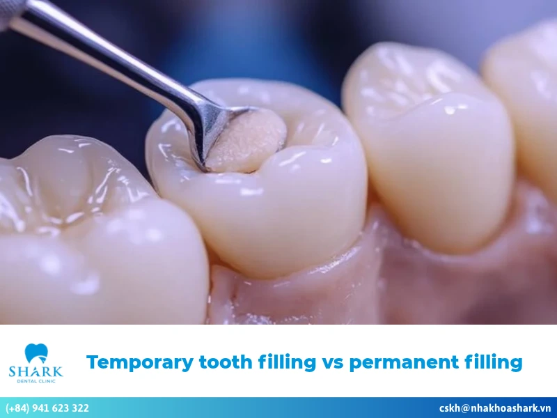The best guide to temporary tooth filling vs permanent filling