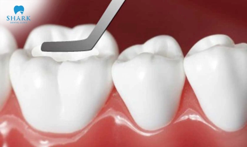 A temporary tooth filling uses a soft filling material, applied over a short period of time