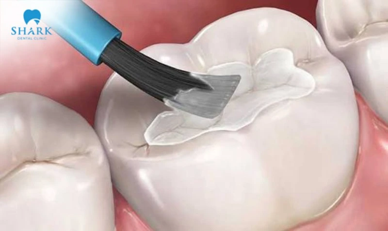 A permanent filling takes longer and involves a greater degree of complexity