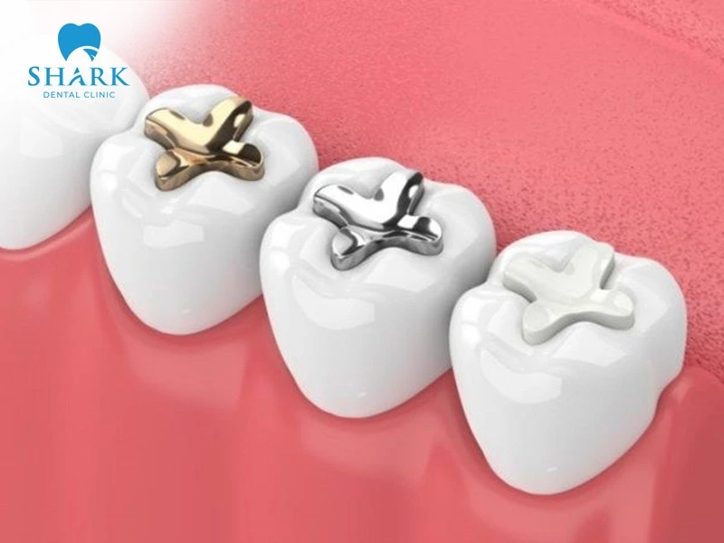 Be sure to contact your dentist right away if your temporary filling falls out
